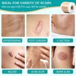 Emibele Silicone Scar Sheets (1.6"x 120"Roll-3M), Silicone Scar Tape, Professional Scar Gel Reusable Scar Roll, Soft Breathable Scar Removal Strip for Keloid,Acne,C-Section,Surgery,Burn Scar,Trauma,et - Image 4